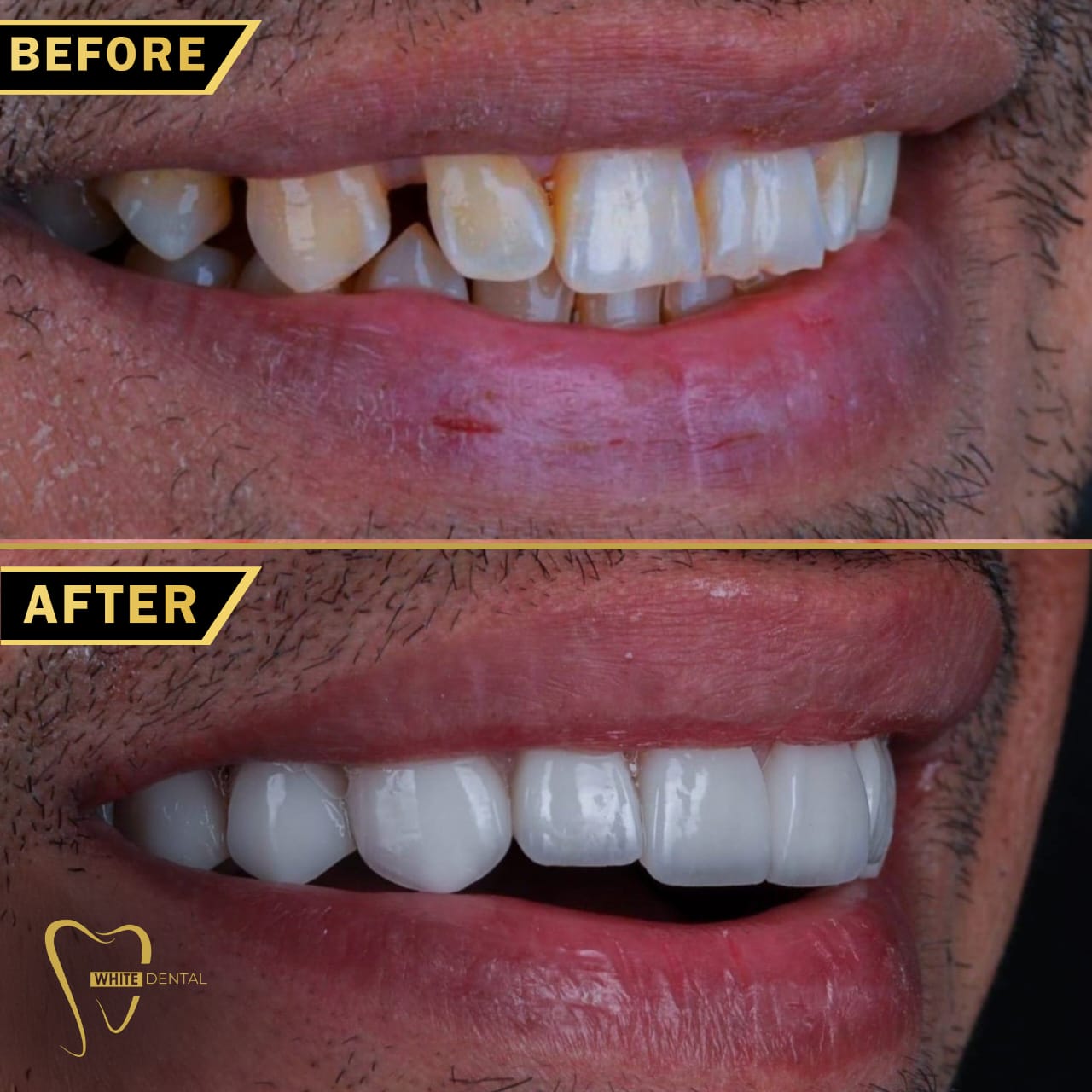 whitening case 1