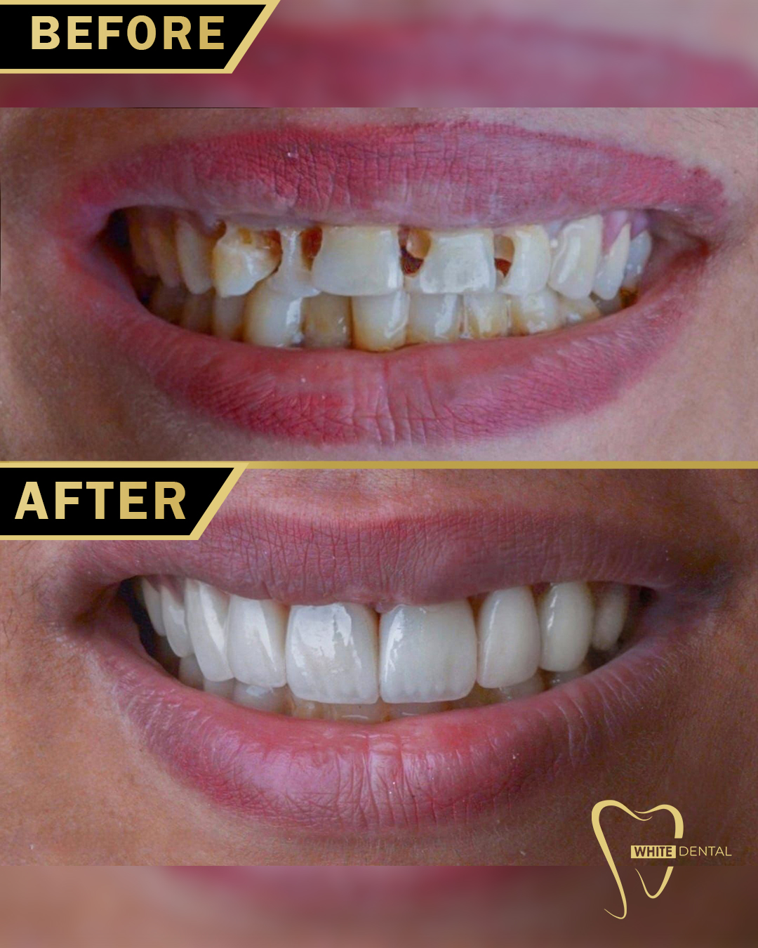 whitening case 2