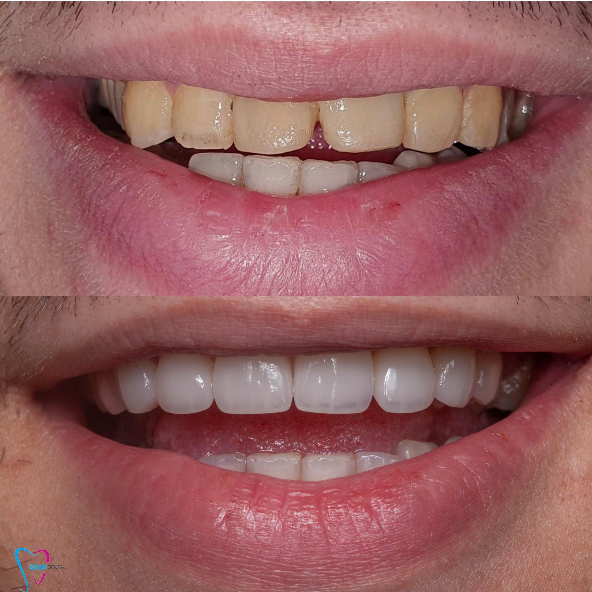whitening case 3