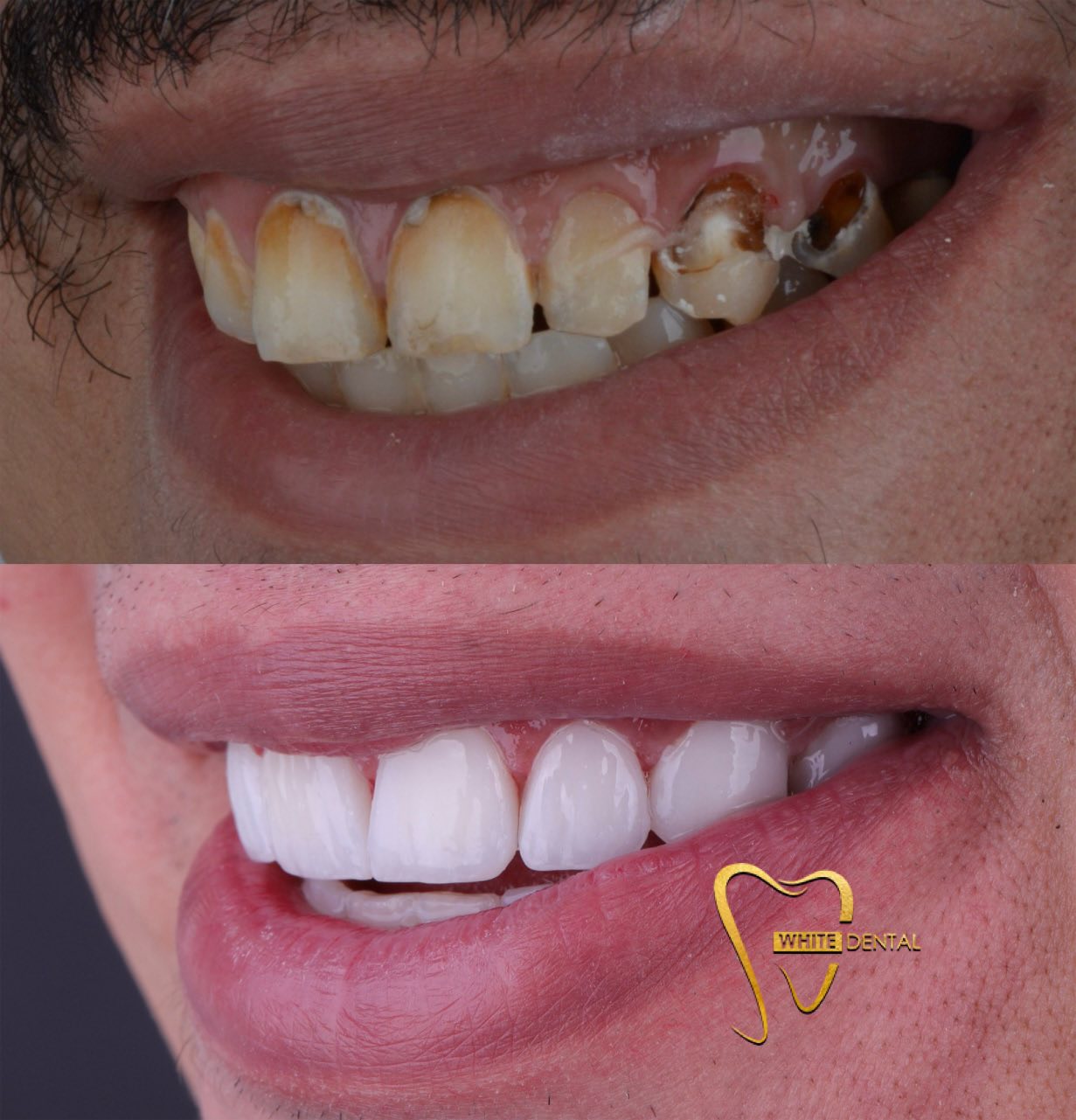 whitening case 4