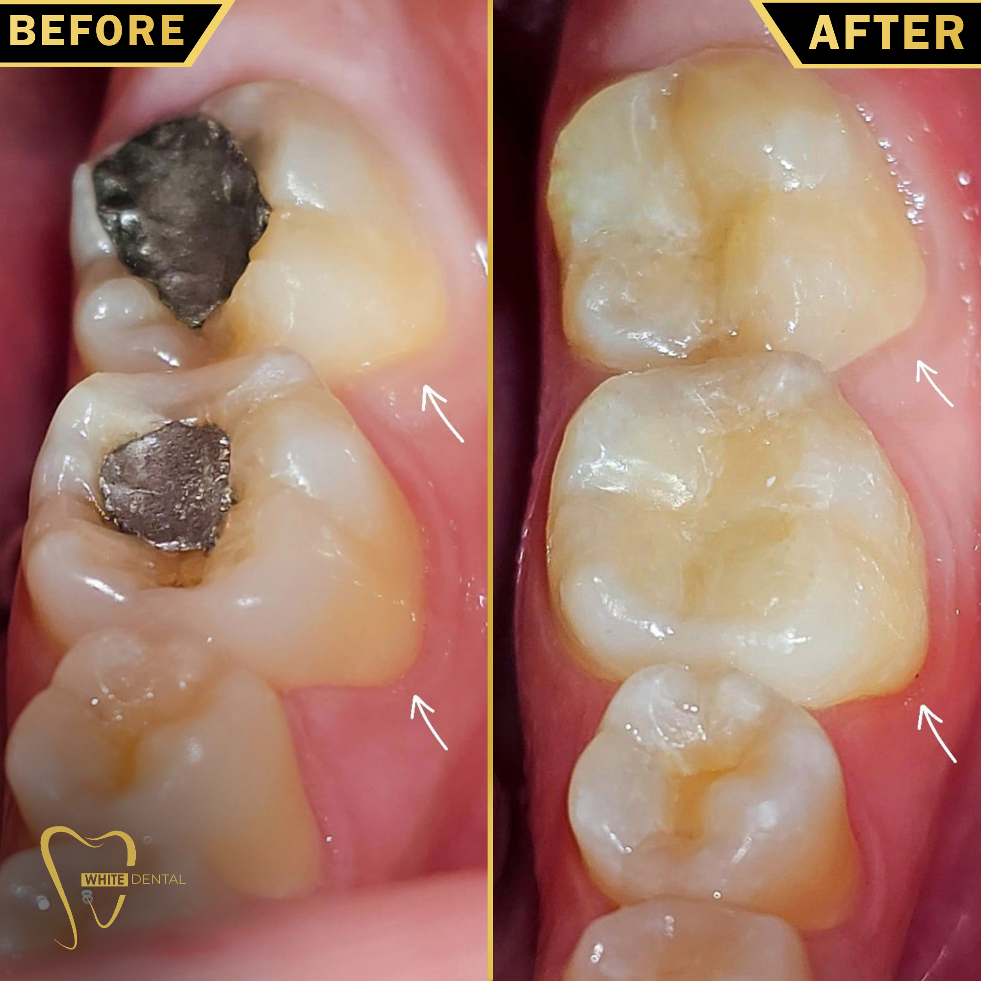 fillings case 1