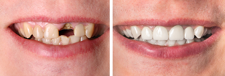 fillings case 2