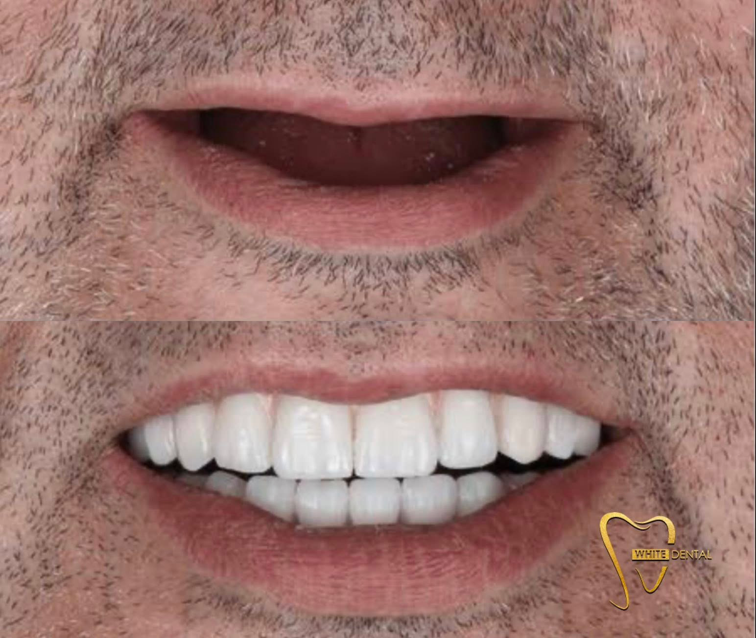 implant case 1