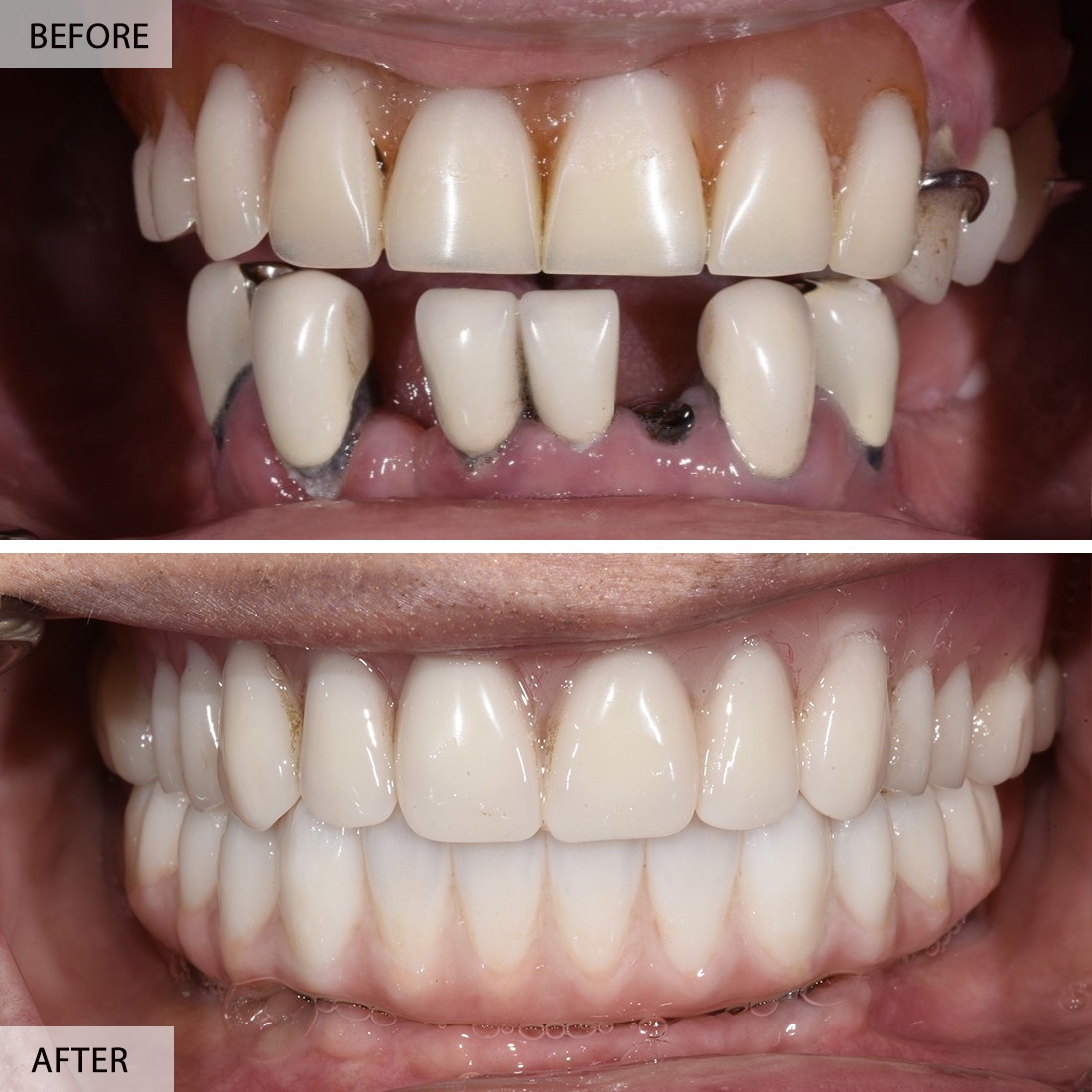 implant case 2