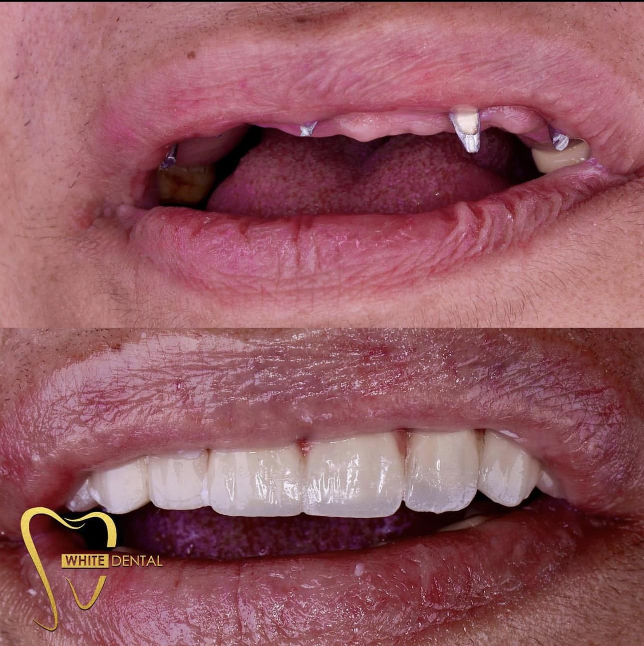 implant case 4