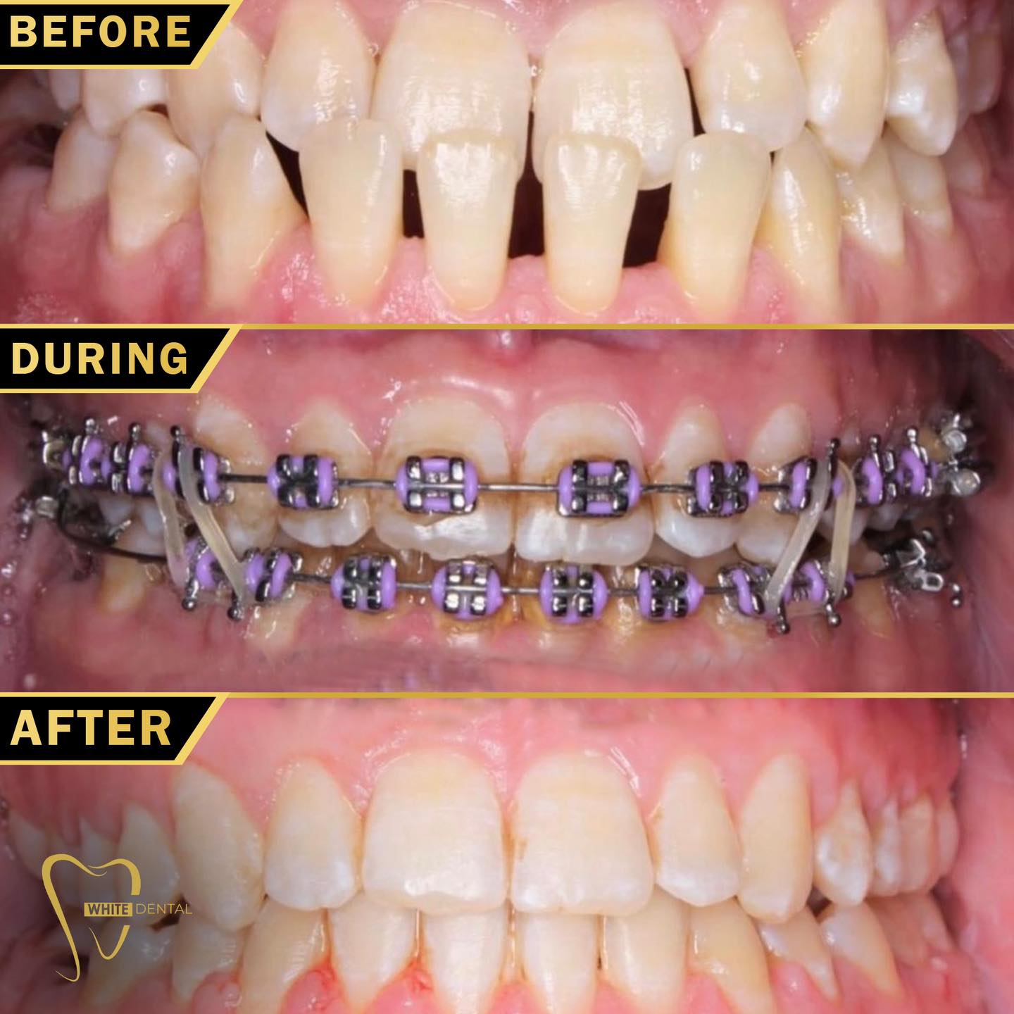 orthodontics case 3