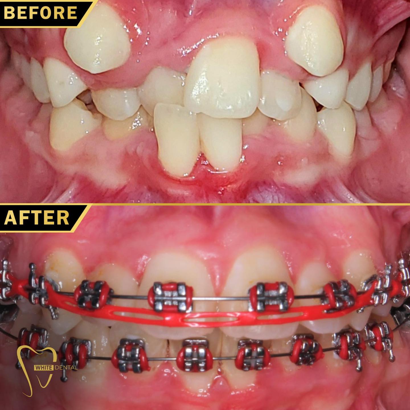 orthodontics case 4