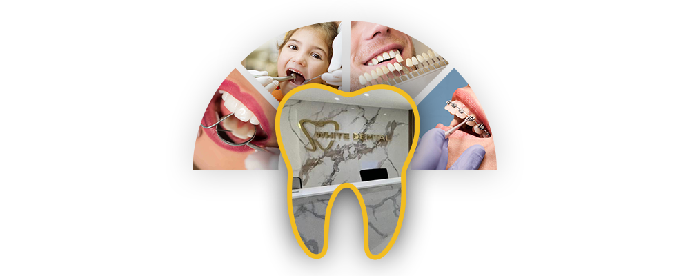 Teeth Cleaning